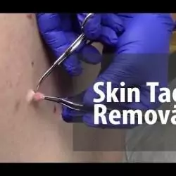 SKIN TAG REMOVAL